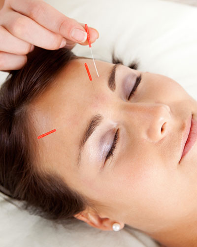 Points d'acupuncture